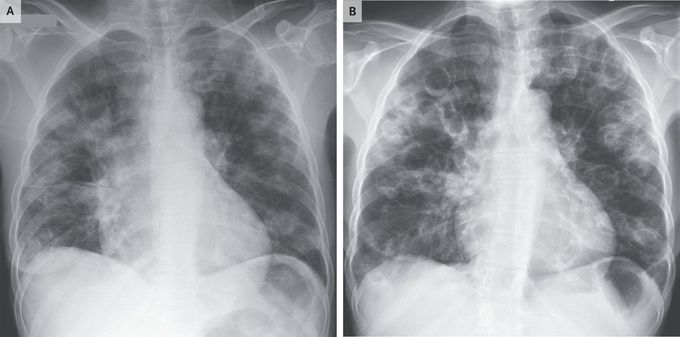 Radiographic Evolution of Presumed Septic Pulmonary Emboli