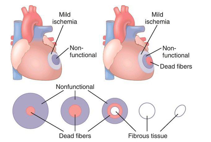 Coronary ischemia and recovery