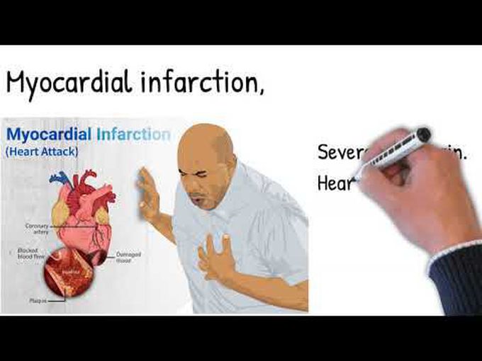 Myocardial Infarction-Overview