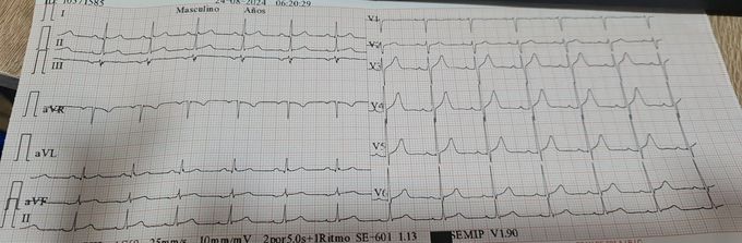 Chest pain associated with cryodiaphoresis
