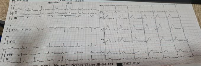 Chest pain associated with cryodiaphoresis