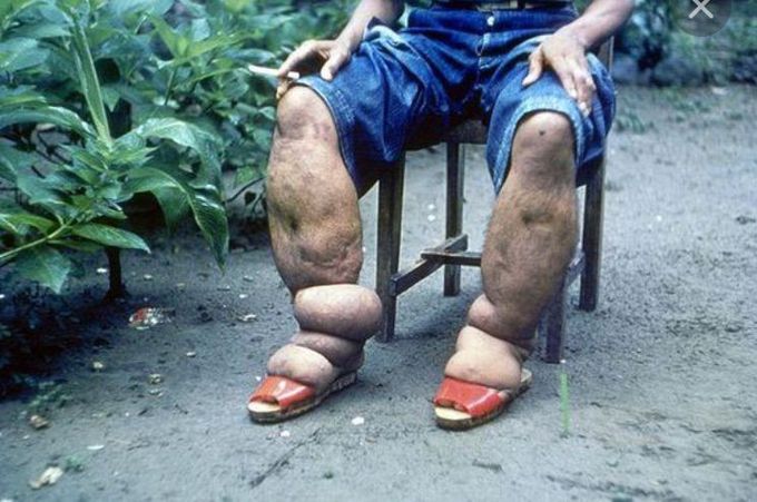 Elephantiasis