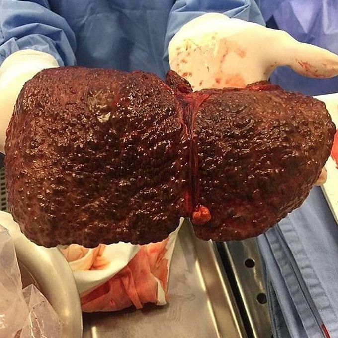 Patient with hepatitis C-related liver cirrhosis receives a liver transplant from a deceased donor!!