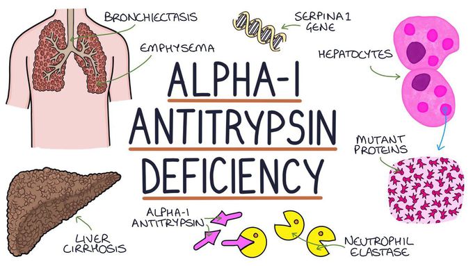 Alpha-1 antitrypsin (AAT) deficiency