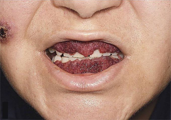 Strawberry Gingivitis