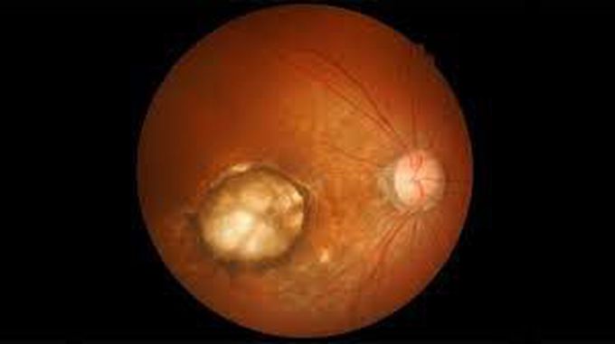 Retinal hole