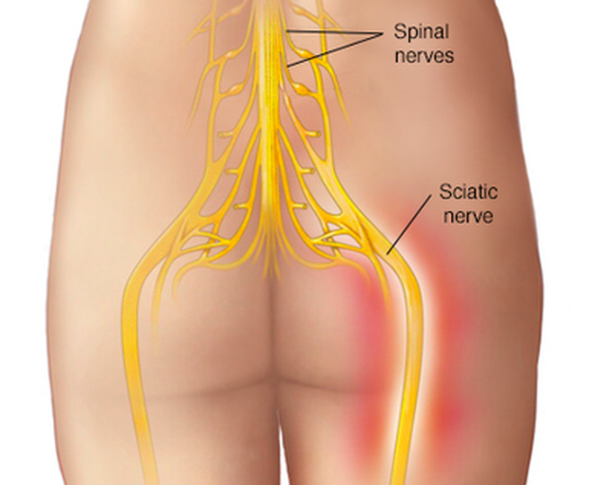 SCIATICA-NERVE PULLING SYNDROME