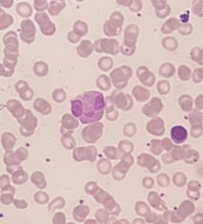 Smiley Eosinophil