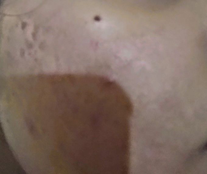 Irritant Contact Dermatitis