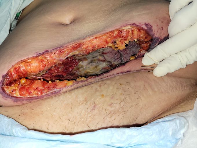 Necrotizing Fasciitis