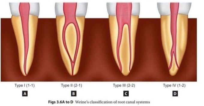 Weine's Classification for root canal - MEDizzy