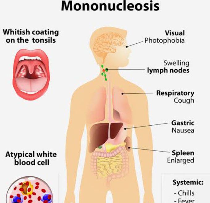 Cause of Mononucleosis