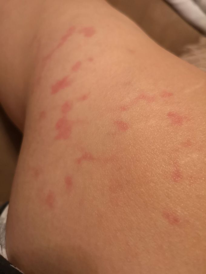 Dermatology