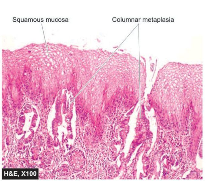 Columnar metaplasia oesophagus (Barrett’s oesophagus).