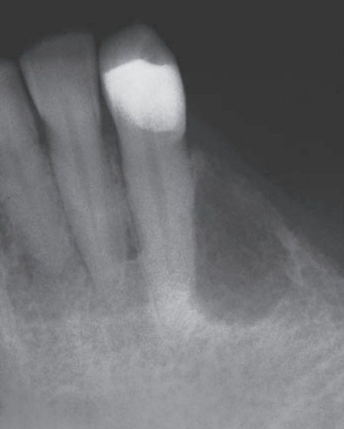 Odontogenic keratocyst