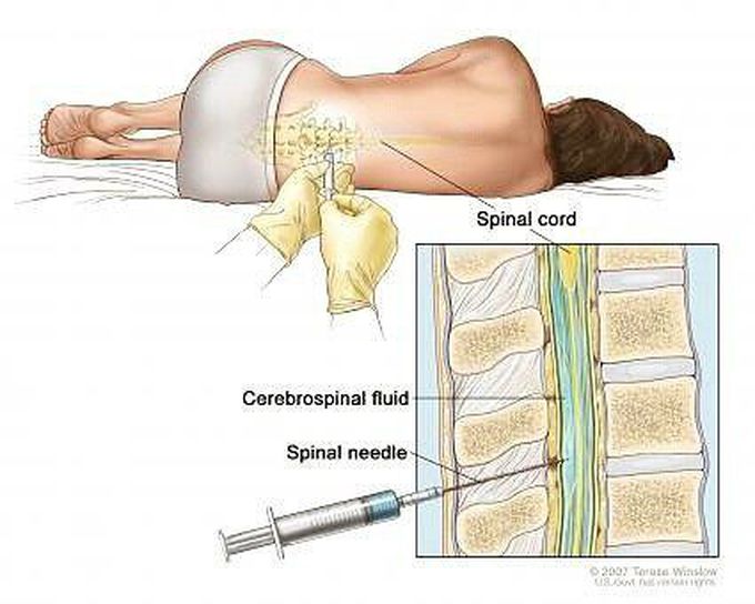 Lumbar Puncture MEDizzy