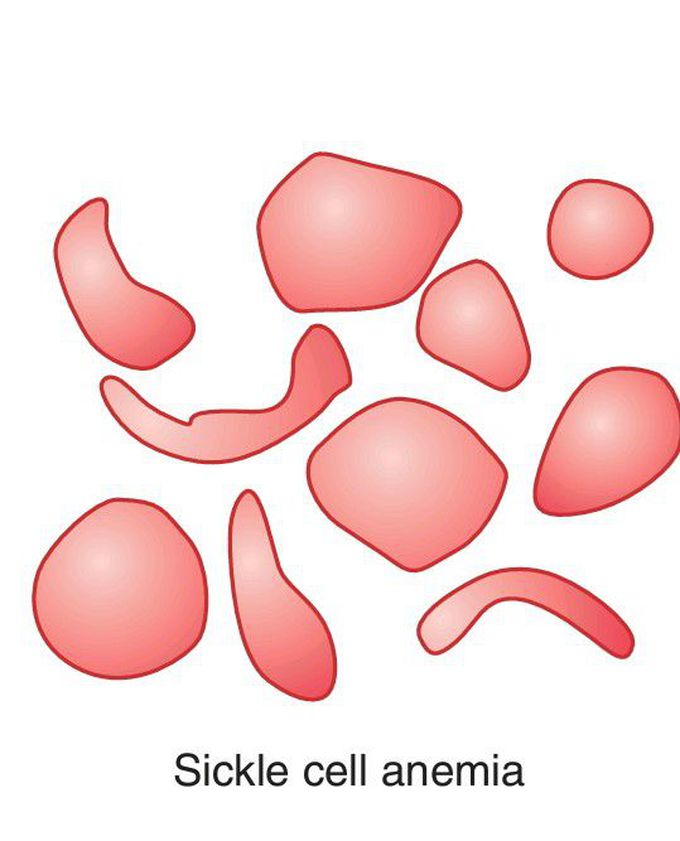 Characteristics of RBCs in different types of anemias.(2)