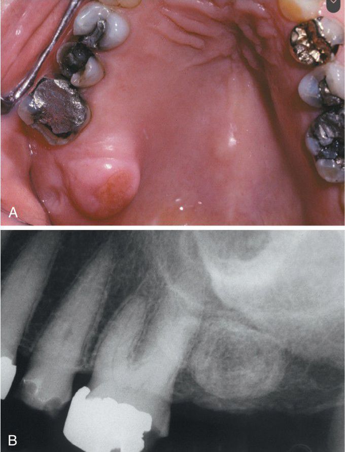 Exostosis