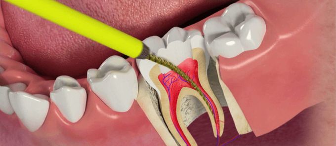 Treatment for Pulpitis