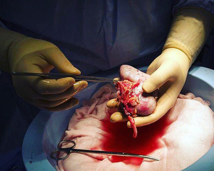 Surgeon holds and prepares a donated harvested kidney for transplantation