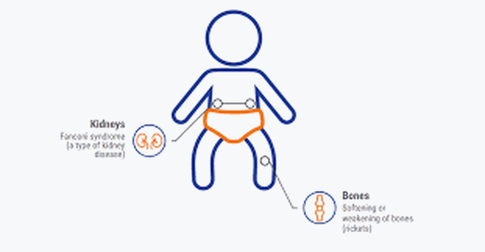 Cystinosis symptoms