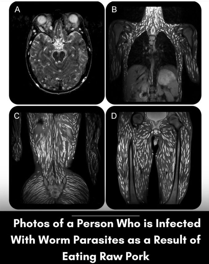 Person Infected With Worm Parasites