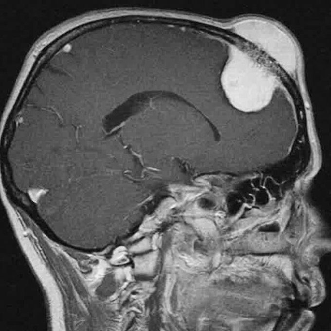 Interesting case of an intraosseous hemangioma of the frontal bone!
