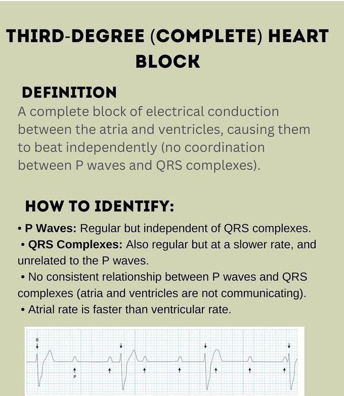 Third Degree Heart Block