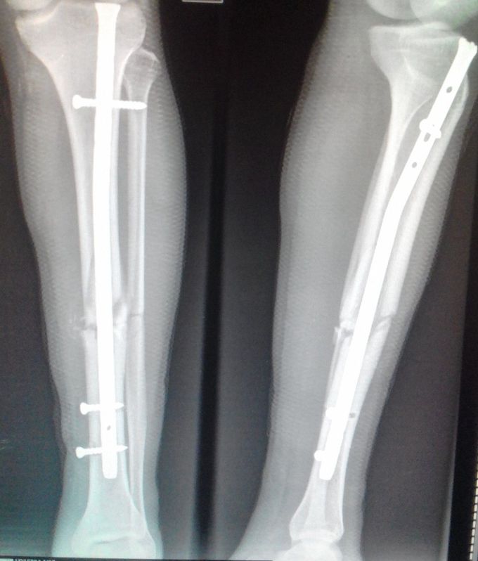 X-Ray Lower extremities😆