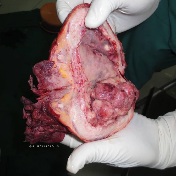 Bladder tumor