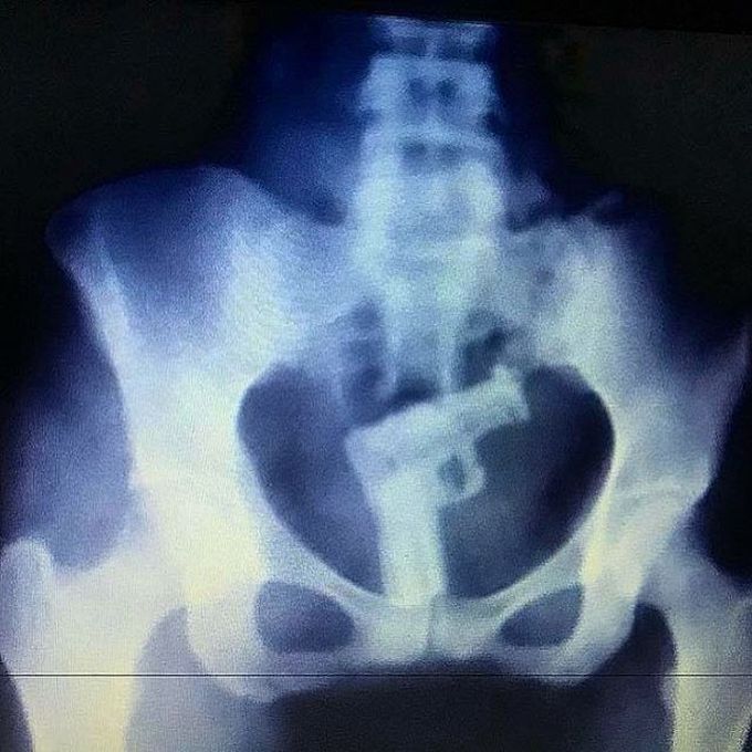 Weirdest X-ray award goes to this patient for both bravery and creativity!