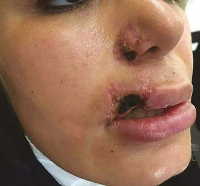 A 25-year-old woman suffered tissue death on part of her lip and nose after having fillers! 
