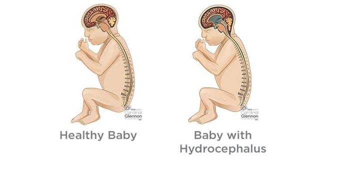 Hydrocephalus