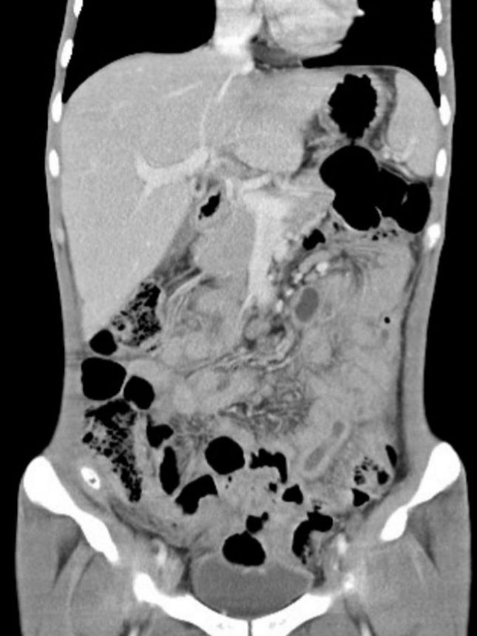 Hello. What is the diagnosis . 21old male , symptoms: weight loss, poor appetite, abdominal cramping and diarrhea