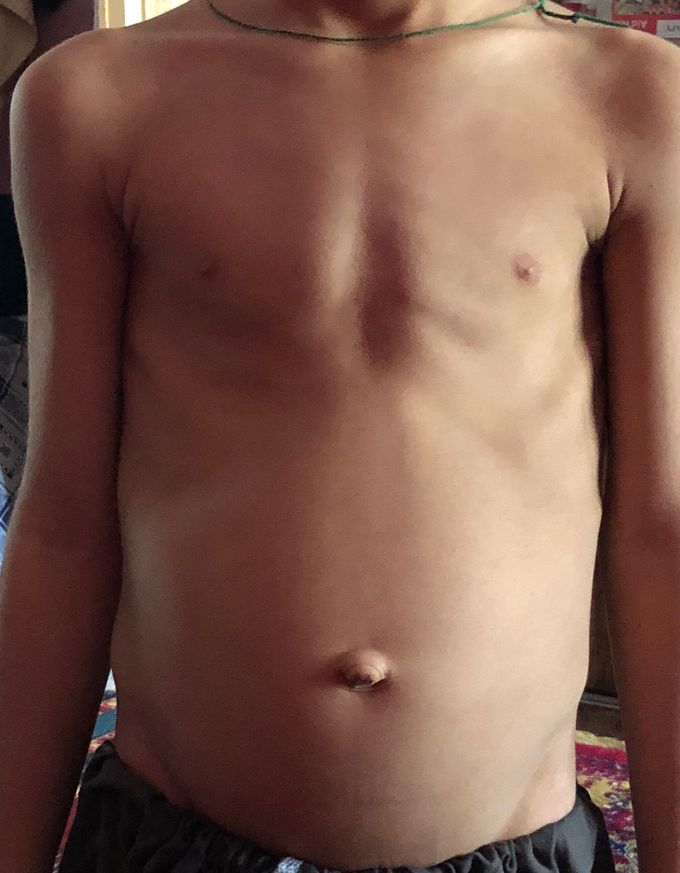 Osteodysgenesis