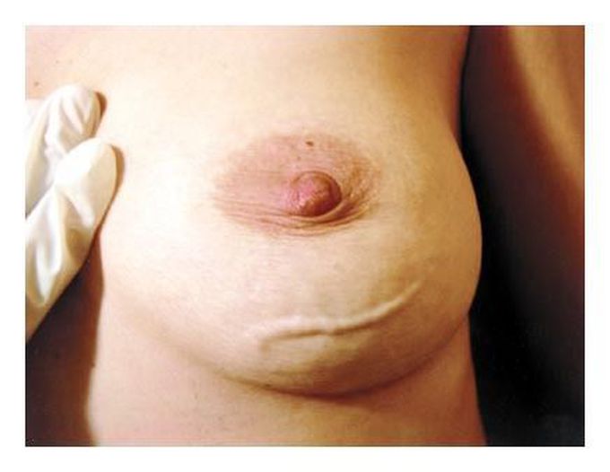 Mondor's Disease