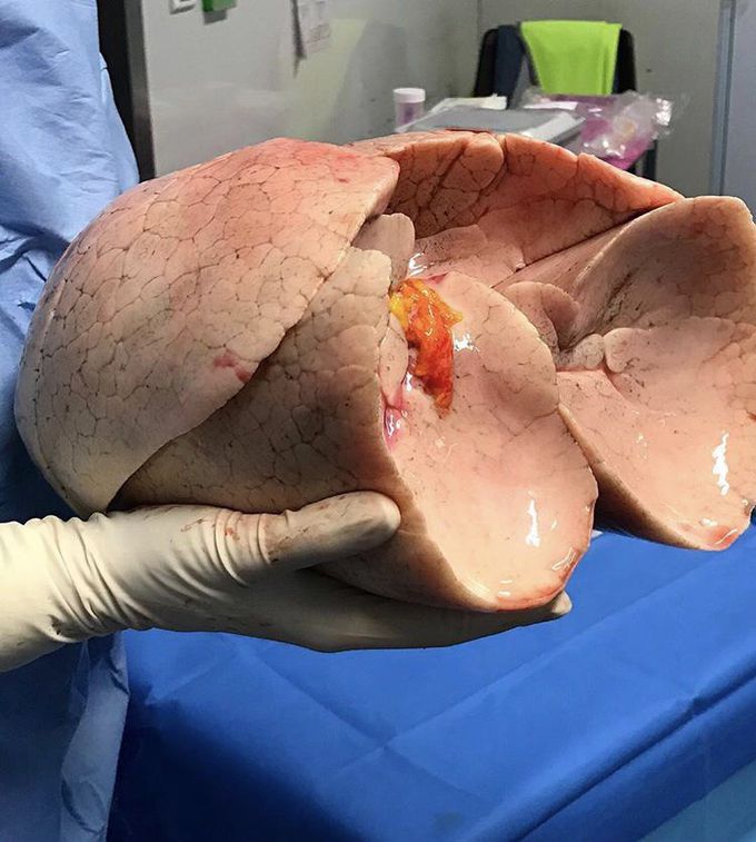Beautiful pair of lungs before transplantation! 