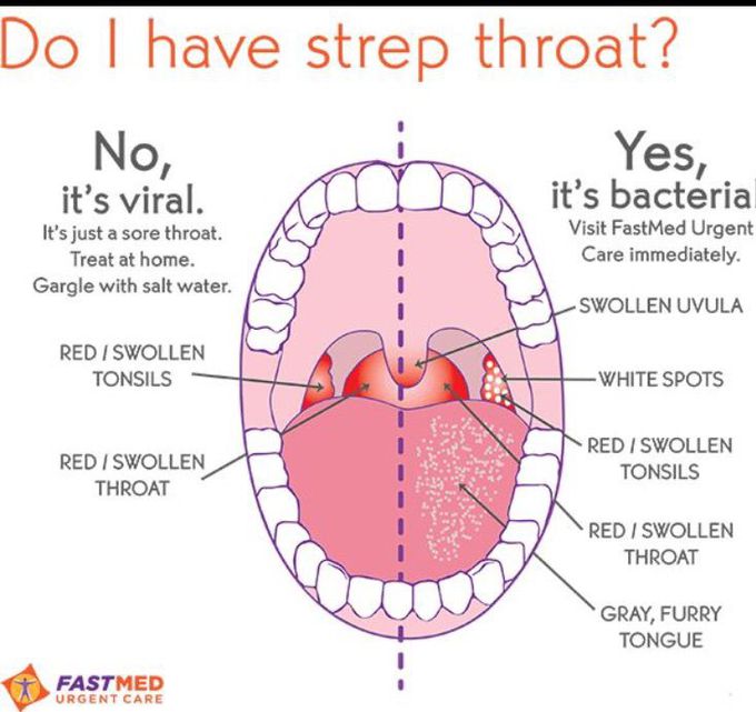 tonsillitis