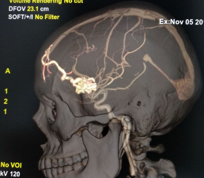 AV malformation