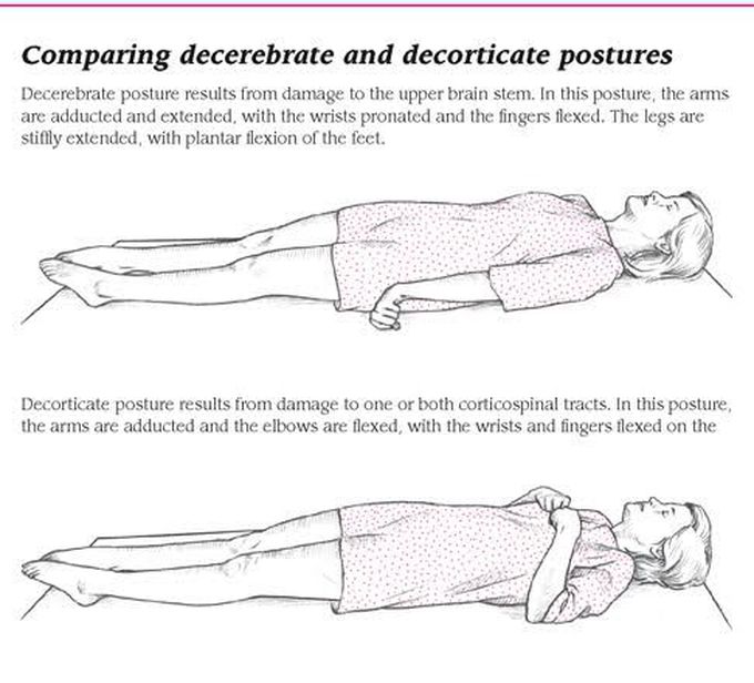 Decorticate vs Decerebrate Posture
