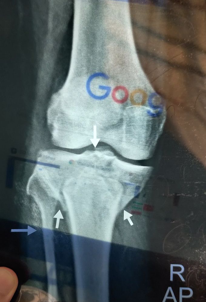 Fracture Tibia + Fibula