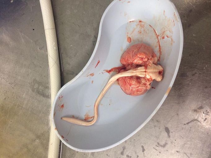 Baby's cerebellum, medulla oblongata and spinal cord. Autopsia.
