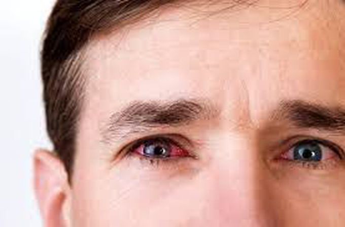 Symptoms of conjunctivitis