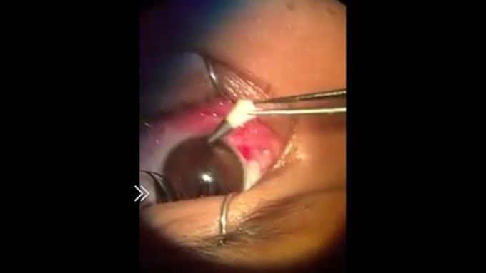 Small boy eye operation for take out pencil lid from his eye