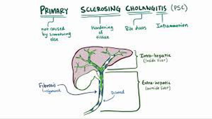 Sclerosing cholangitis causes