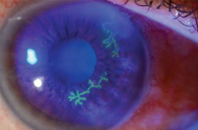 Herpes simplex keratitis