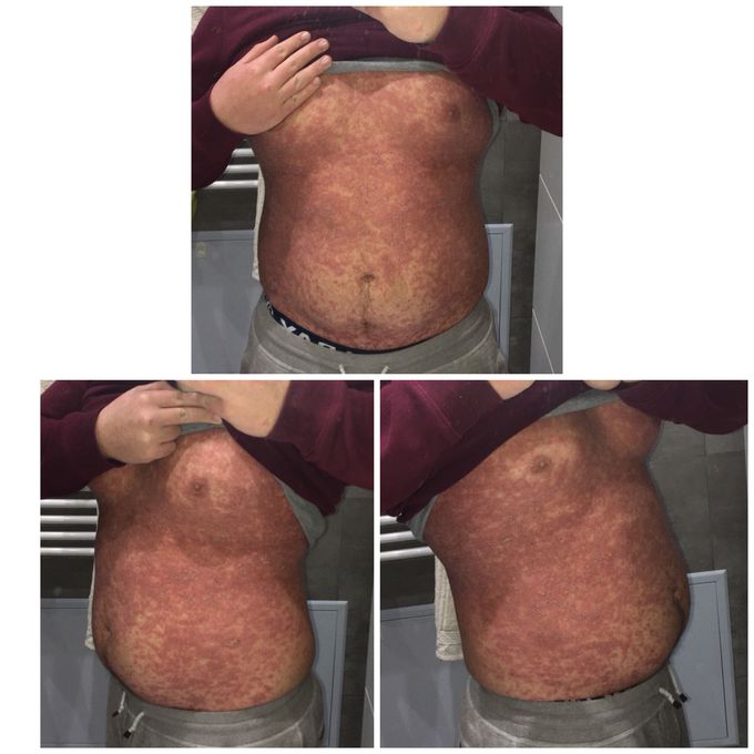 Skin Disease