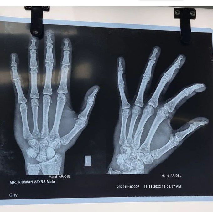 Locate the Fracture