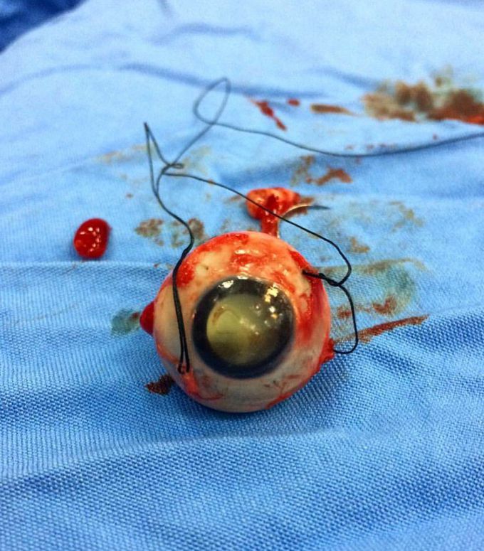 Enucleation