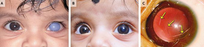 Sudden Unilateral Corneal Clouding in an Infant